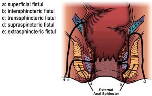 fistul-belirtisi